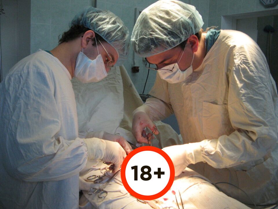 performance of penis enlargement surgery