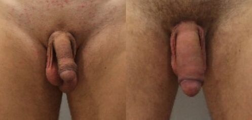 Before and after penis enlargement