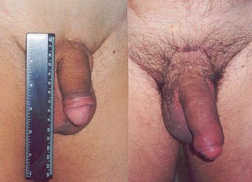 Penis length before and after enlargement surgery