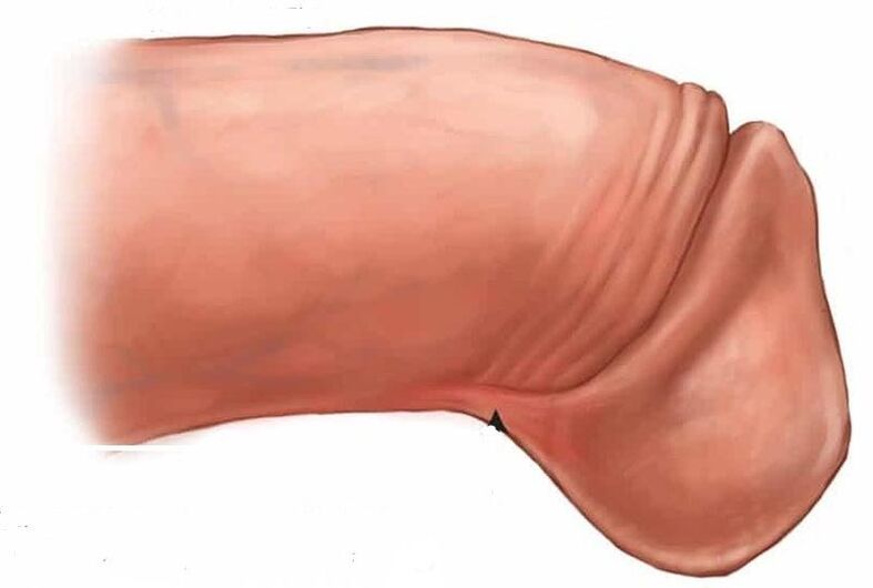 How to enlarge the glans penis